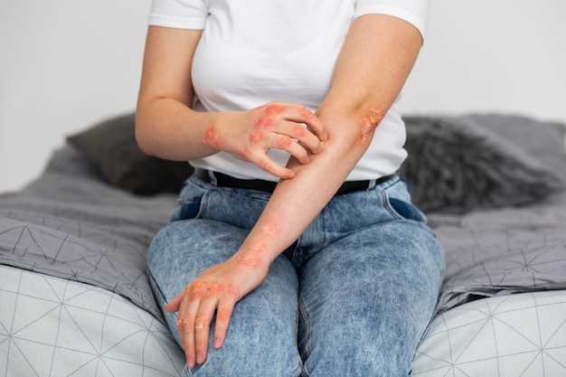 Fluoxetine cause rashes