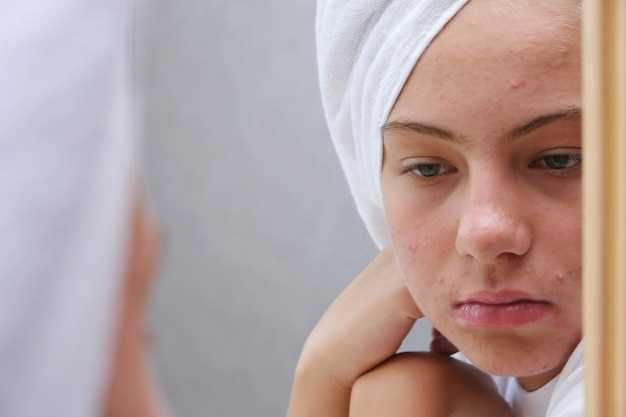Fluoxetine causes acne